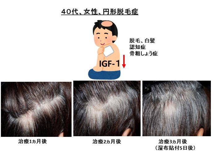 円形脱毛症　病院